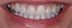 Teeth with overbite before