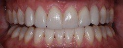 Closed and properly aligned smile after treatment