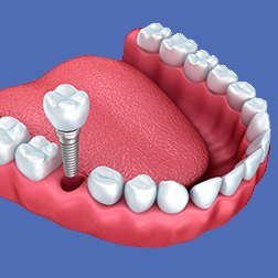 Icon of dental implant with crown being placed in jaw