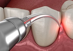 Using soft tissue lasers to treat gums