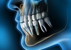 Animation of implant supported dental crown