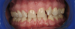 Closeup of teeth with gaps
