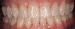 Clsoeup of perfectly aligned smile aftre Invisalign treatment