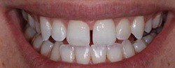 Gap between front teeth