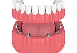 Digital model of implant denture