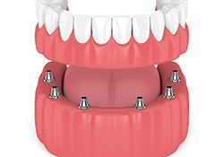 Digital model of implant denture