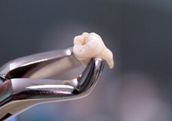 dental forceps holding an extracted tooth