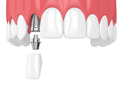 single dental implant being placed in the upper jaw 