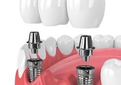 dental bridge being placed over two dental implants 