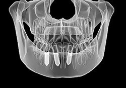 X-ray of a patient’s jaw with dental implants
