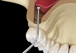 sinus lift procedure