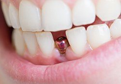 close up of a dental implant and abutment in someone’s mouth