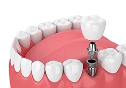 dental implant post with abutment and crown