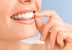 Closeup of patient removing her Invisalign clear braces