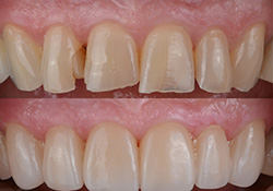Before and after of a smile makeover
