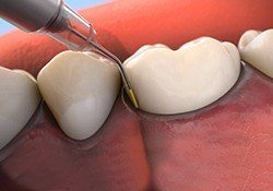 Animation of gum disease treatment process