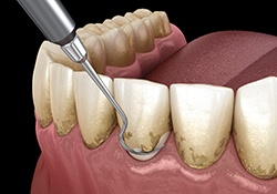 Illustration of scaling of the teeth