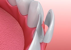 Animation of porcelain veneer placement