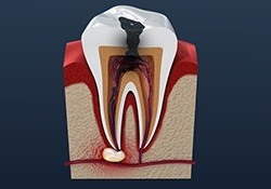 Animation of damaged tooth