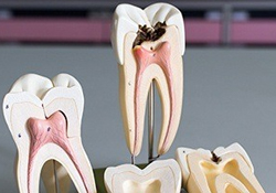 Models of healthy and damaged teeth