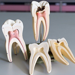 Models of healthy and damaged teeth