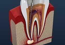 Animtion of root canal treatment