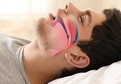 Man sleeping with airway animation on his profile