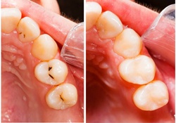 decay and tooth-colored fillings