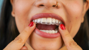 Patient inserting Invisalign aligner